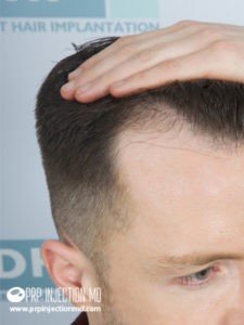 Hair-Transplant-Image-PRP-image