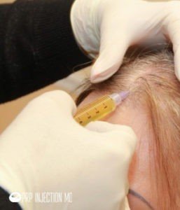 PRP-Injection-Hair-Image-PRP-Image