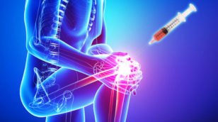 PRP therapy for Arthritis