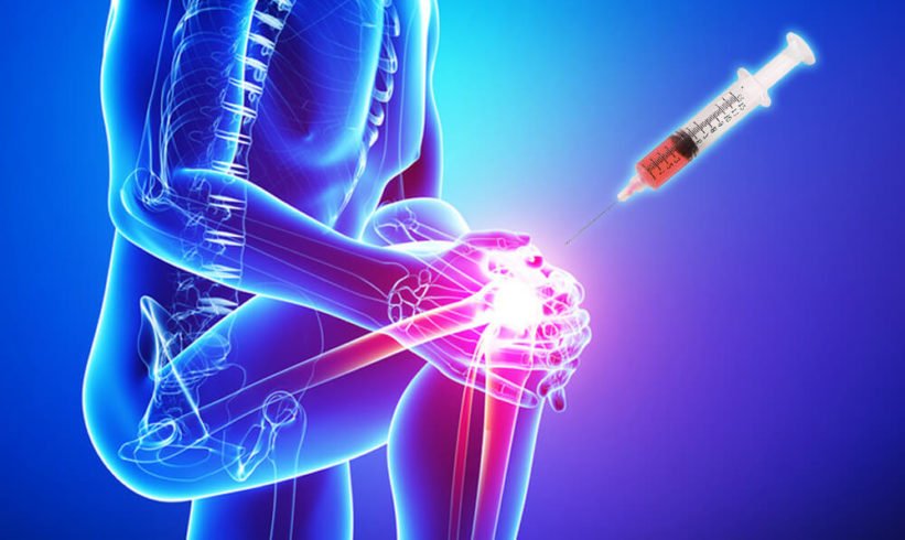PRP therapy for Arthritis