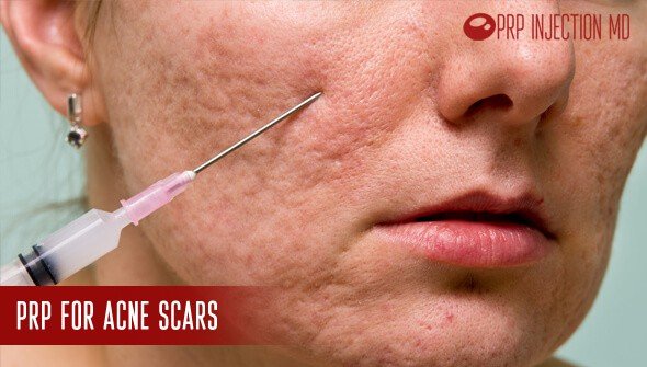 prp-for-acne-scars-platelet-rich-plasma-therapy-prp-injection-md