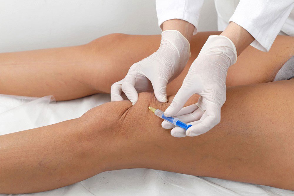 prp-knee-injection