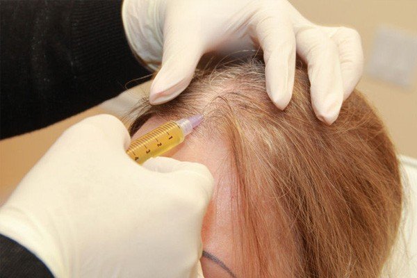 PRP Hair Treatment Permanent Solution Image