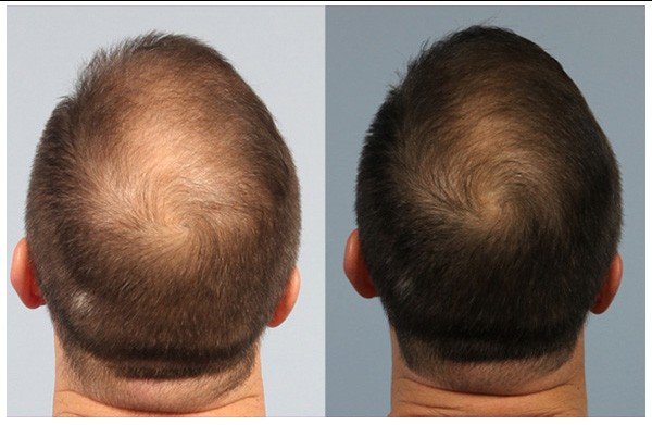 PRP Before and After Hair Treatments Image - PRP