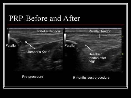 PRP Treatment Reviews for Tendon Injuries Image - PRP