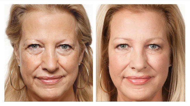 PRP Undereyes Before and After Image - PRP