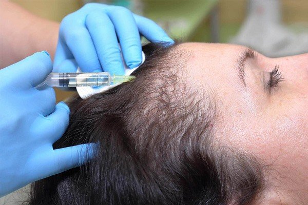 Does Stem Cell Hair Restoration Work Image