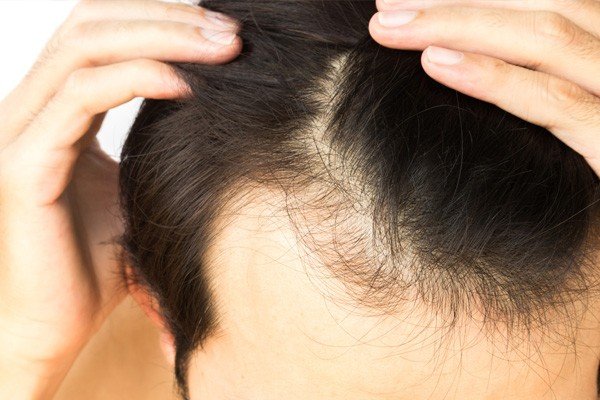 PRP for Hair Regrowth Image