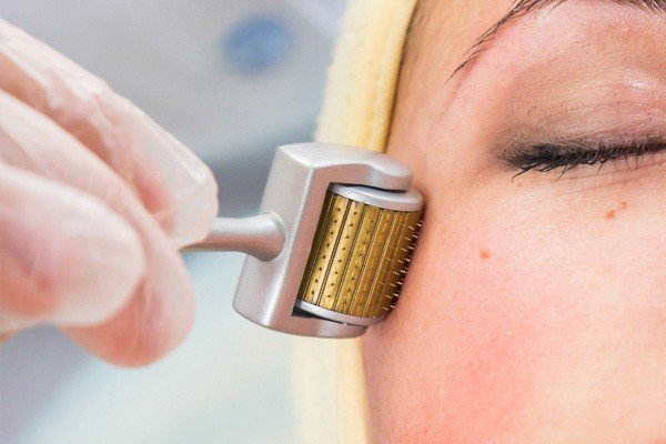 What is Microneedling Image - PRP