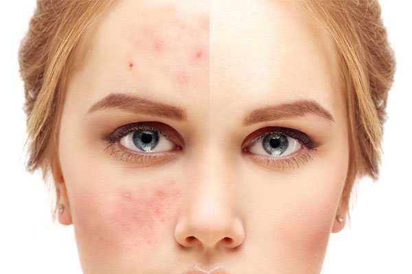 microneedling-for-acne-scars-works