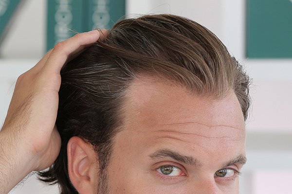 PRP for Hair Loss Efficacy Safety and Cost